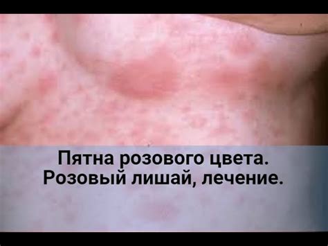 Розовый лишай у человека: симптомы, лечение, фото