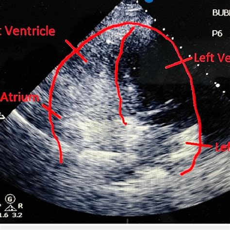 Bubble Study Showing Significant Right To Left Shunting Across PFO