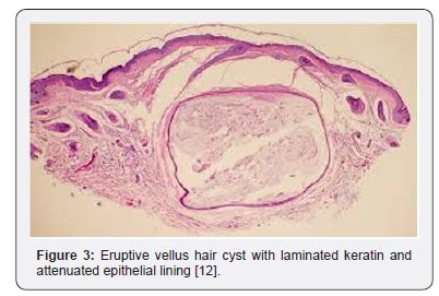 Top 111 + Eruptive vellus hair cysts cause - polarrunningexpeditions