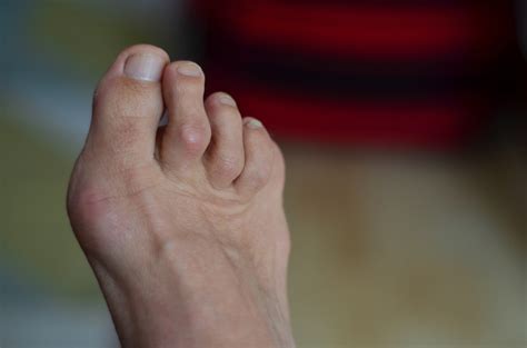 Hammer Toes Medical Channel Asia
