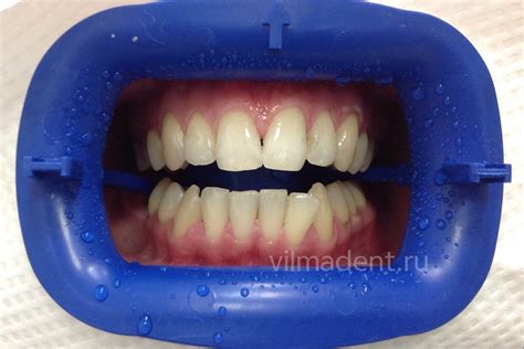 Отбеливание «Opalescence» - ПортфолиоВилмаДент