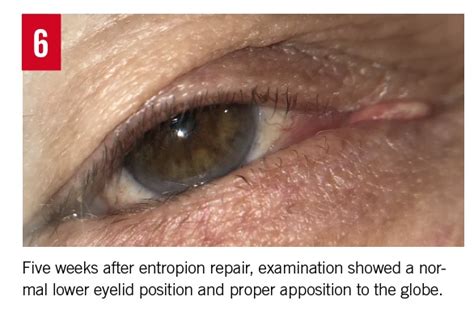 Entropion Etiology Classification Diagnosis And Treatment