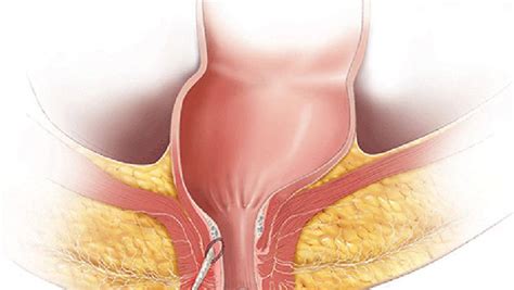 What Happens If Anal Fistula Is Not Treated On Time Dr Samrat Jankar