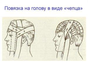 Медицинская повязка на голову как называется. Повязка чепец - техника ...