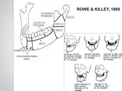 Classification Of Mandible Fracture Ppt