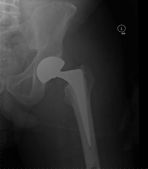 Immediate Postoperative Radiographs Post Total Hip Arthroplasty