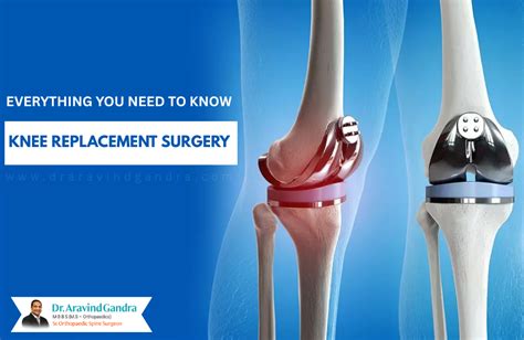 knee replacement surgery
