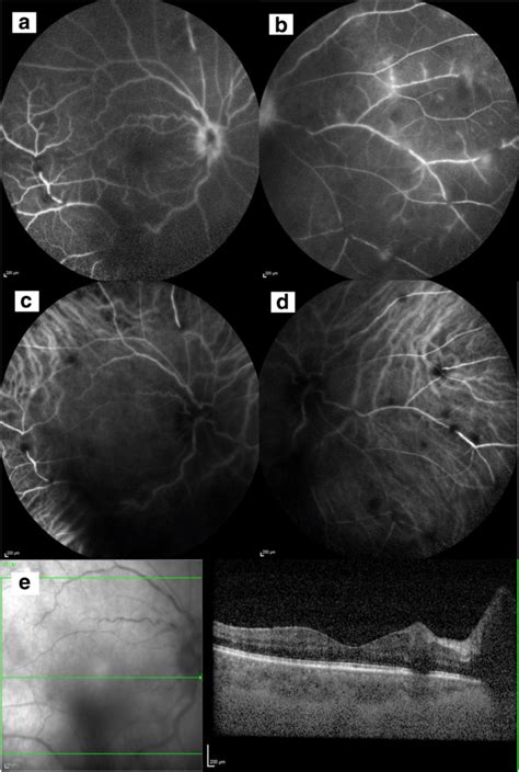 Baseline Investigations Of The Right Eye Fundus Fluorescein Angiogram