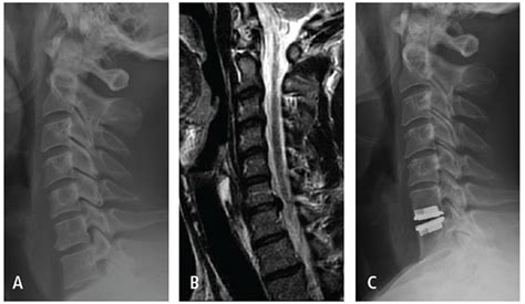 Cervical Spine Nerves Impingement X Ray Gastmid