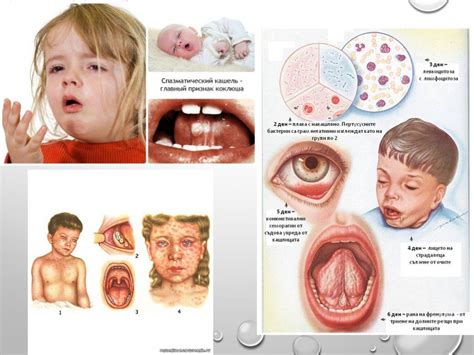 Коклюш: клиническая картина, как проявляется и чем опасен для детей