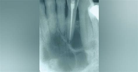 central giant cell granuloma aggressive lesion   jaw  swell
