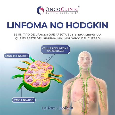 O Que Linfoma Não Hodgkin - Linfoma No Hodgkin Linfoma No Hodgkin | Linfoma Difuso De Células B
