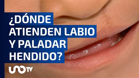 Cdmx Ofrece Tratamiento Gratuito Para Labio Y Paladar Hendido Youtube