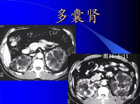 多囊肝和肝內多發囊腫一樣嗎？ 每日頭條