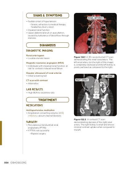 Renal Artery Stenosis Video Causes And Meaning Osmosis