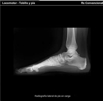 Anatomía De La Radiografía Lateral Del Pie Biomecánica Del Pie Cavo