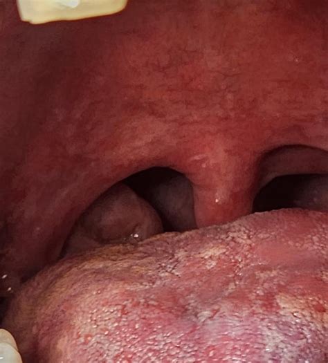 Swollen Tonsils Spots R Askdentists