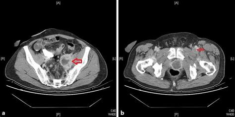 A 61 Year Old Man With Recurrent Urinary Bladder Urothelial Carcinoma Download Scientific