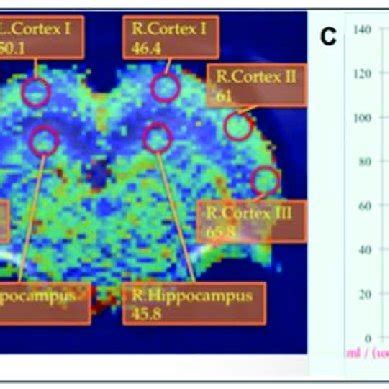 Rcbf Values Of The Hippocampus And Cortex Region Images Of Control