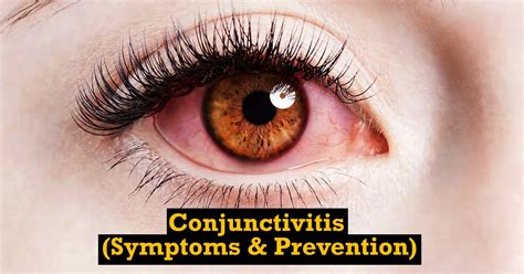 Conjunctivitis Pink Eye Symptoms And How To Prevent