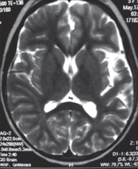 JLE Epileptic Disorders Rasmussen Syndrome An Atypical