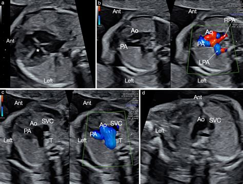 Canal Arterial Fetal Complete Atrioventricular Canal Defect (CAVC)