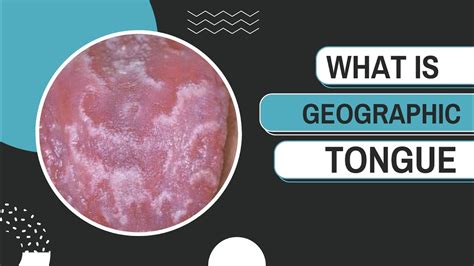 What Is Geographic Tongue Causes Symptoms And Management Youtube