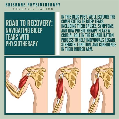 Bicep Tears - Torn Bicep Symptoms, Causes, Physio & Rehab - Brisbane