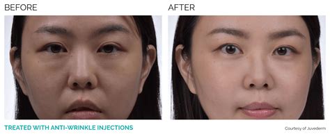 Juvederm Volite Myclinic Aesthetic Clinic Malaysia