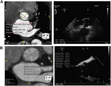 Comparison of Aortic Annulus Size by Transesophageal Echocardiography ...