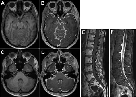 leptomeningeal disease hematologyoncology clinics