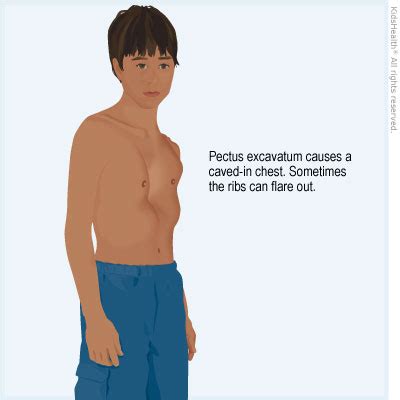 chest wall disorder pectus excavatum rady childrens hospital