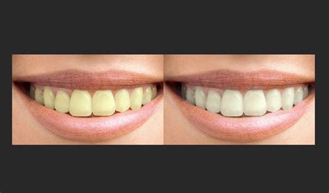 Como Clarear Dentes Em Fotos No Photoshop Dicas E Tutoriais Techtudo