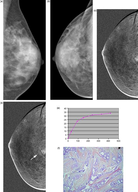 Contrast Enhanced Digital Mammography European Journal Of Radiology