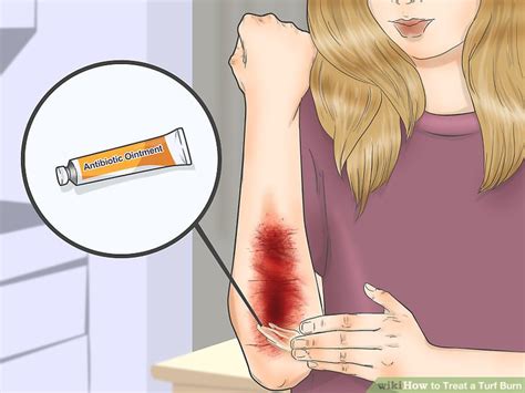 How To Treat A Turf Burn 11 Steps With Pictures Wikihow