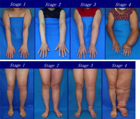 Lymphadema Quiz Flashcards Quizlet