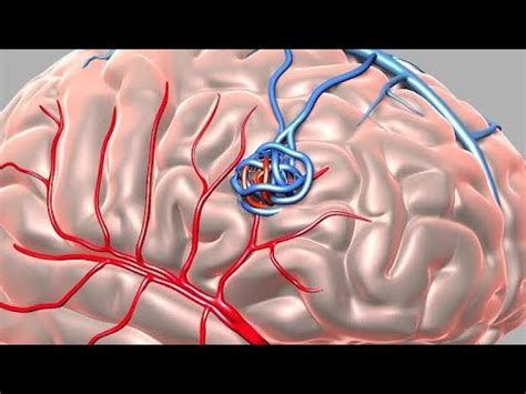 brain avm arteriovenous malformation symptoms  human  mouse