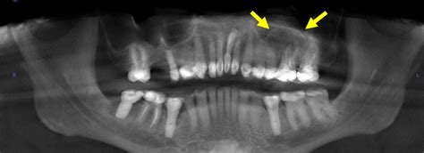 year  woman  left maxilla lesion drbicuspid