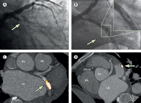 Categorising Myocardial Infarction With Advanced Cardiovascular Imaging