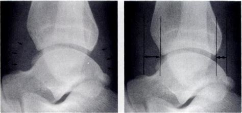 Ankle Effusion X Ray