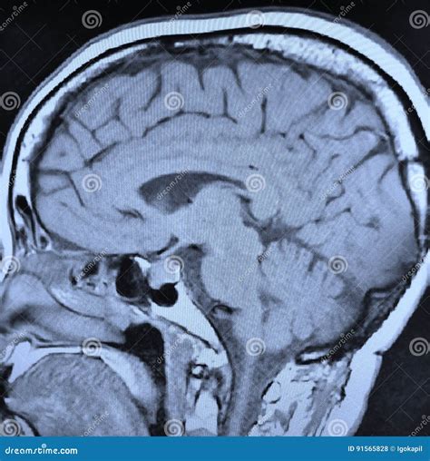 Pituitary Tumor Mri