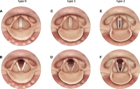 Type 0 A B There Is No Significant Morphological Alteration In