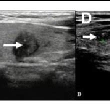 Ultrasound diagnosis of the benign thyroid nodules. A, Ultrasound image ...