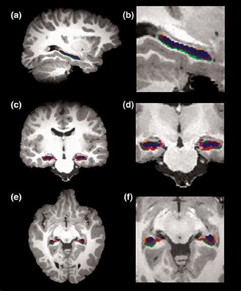 FIG URE 1 Hippocampal Subfield Segmentations Using MAGeT Brain Shown In