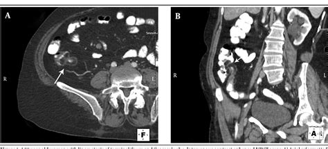 Figure 1 From Lipomatosis Of Terminal Ileum And Ileocecal Valve