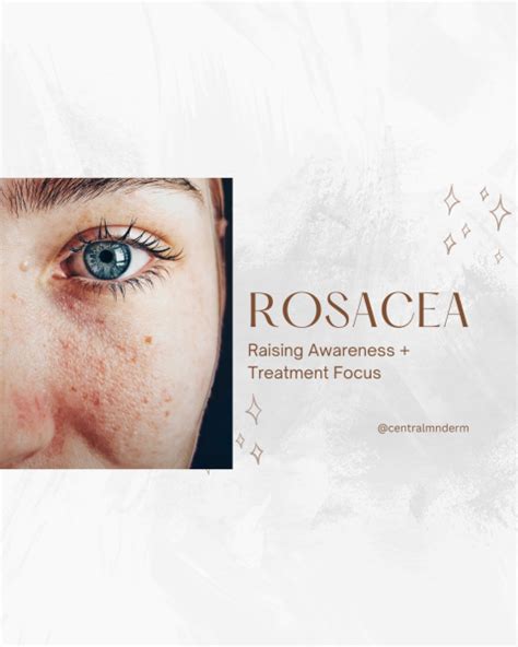 Is It Rosacea Central Minnesota Dermatology Cmd