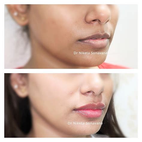 skin whitening treatment  mumbai cost bollywood lightening