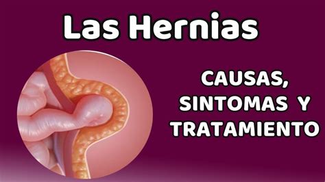 Sintomas De Hernia Abdominal Interna FDPLEARN