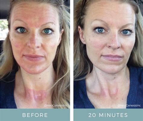Collagen Induction Therapy Before And After Pictures Flash Uganda Media