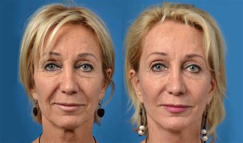 Плазмолифтинг Алматы: инновационные методы омоложения!